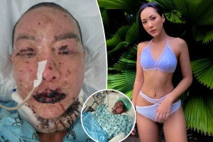A Thai swimsuit model developed rashes and blisters all over her face and body after she was given antibiotics she was allergic to. She has Stevens-Johnson syndrome.