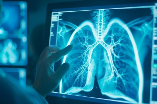 Lung cancer screening can save lives —125,000 deaths from the disease are expected to occur this year in the US.