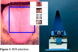 AI tongue analyzer