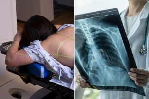 lung cancer