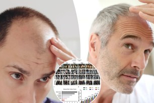 Scientists say they may have accidentally discovered a sugar gel cure for male pattern baldness, a genetic condition that affects up to half of men and a quarter of women by age 50.
